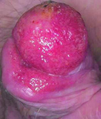 235_erythroplasia_of_queyrat_slide_11_springer_high_es.jpg